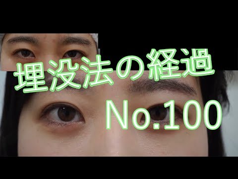 アイプチのライン＋αで埋没法　100