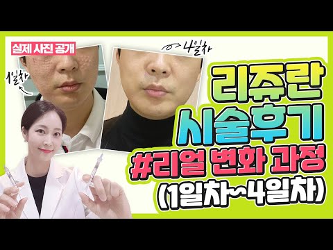 리쥬란 시술❗ 엠보싱 꼭 생기는건가요? 📌시술 방법에 따라 엠보싱이 다릅니다👉 시술 방법에 따라 1일차 ~ 4일차까지 전격비교