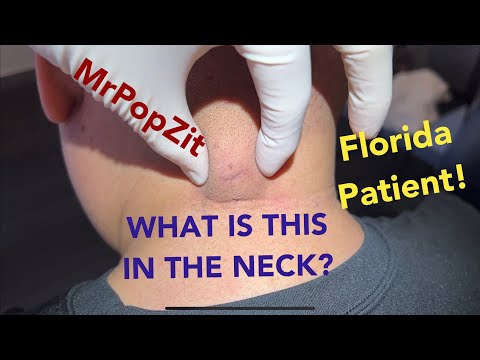 The Florida scar cyst. Patient flies from Florida to have me do his procedure!