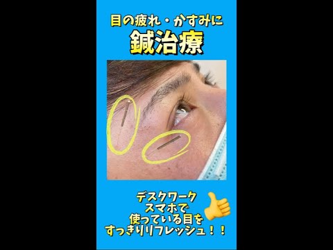 【目の鍼治療】眼精疲労、目のかすみに効果的な鍼治療の流れ｜茨城県結城市　あお整骨院　#short