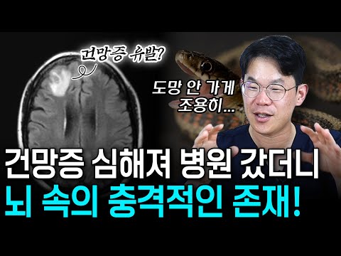 기억이 깜빡깜빡 건망증 심해져 병원 갔더니 뇌 속에서 발견된 충격적인 존재! | 의학 전문채널