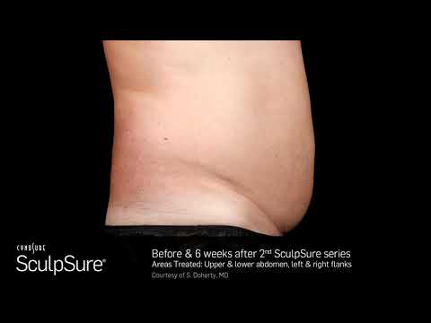 【SculpSure】絲酷秀體外雷射減脂 (如稱酷熱雷射) 大範圍均勻減脂，精雕曲線