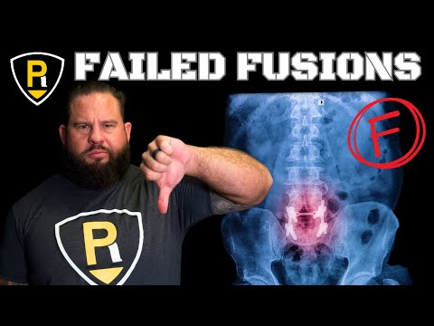 Spinal Fusions Fail (WHY??)