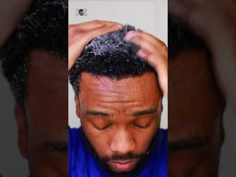 Hair Transplant Week 32👨🏾‍🦲‼️