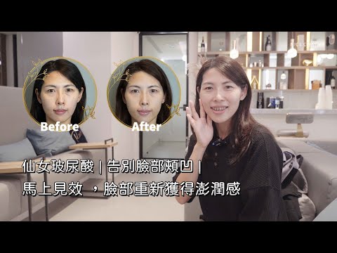 仙女玻尿酸｜告別臉部頰凹問題｜一針下去，馬上見效 回復臉部澎潤感