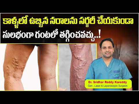 Varicose Veins Causes and Treatment || Varicose Veins Symptoms in Telugu || Treatment Range Hospital