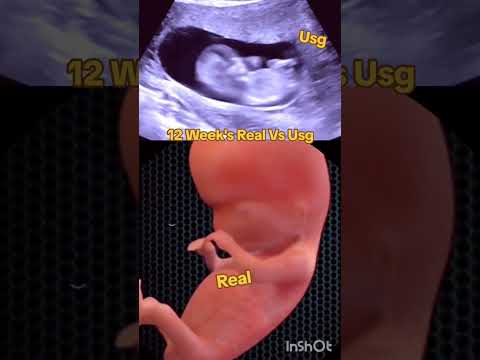 12 Week's real vs usg baby #babyultrasound #pregancyultrasound #baby #pregnancyscan