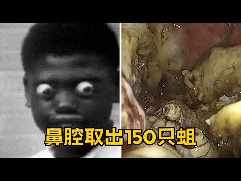 飞机行李舱掉蛆至飞机返航 佛州男子鼻腔取出150只蛆