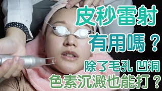 皮秒雷射有用嗎？除了毛孔凹洞，色素沉澱、斑點、暗沉也能打？ft.台北美麗晶華診所