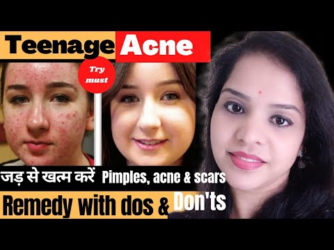 remove pimples acne scars permanently at home with natural remedies. घर पर ही करे पिंपल treatment