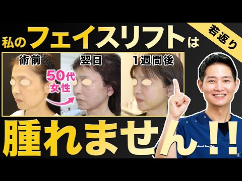 【たるみ解消】切開フェイスリフトは術後に病むの？気になるダウンタイムを大公開！