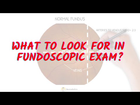 What to look for in fundoscopic exam Neuroaholics