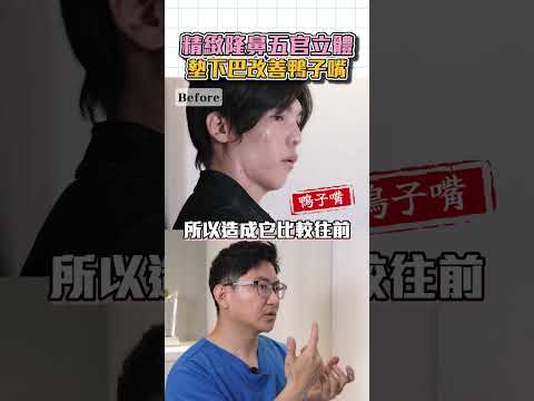 知名作家口罩男 擺脫容貌焦慮！精緻隆鼻+墊下巴+墊法令 改善鴨子嘴  台北教主醫美整形 Dr.郭菁松醫師 #三段式隆鼻 #鼻中膈延長 #法令紋手術 #法令紋 #墊下巴手術 #台北隆鼻 #郭菁松醫師