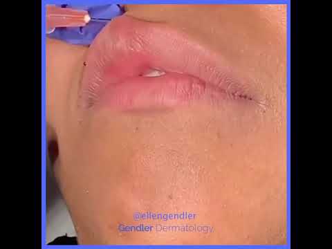 Natural-looking, Pouty Lips with Juvederm I Gendler Dermatology