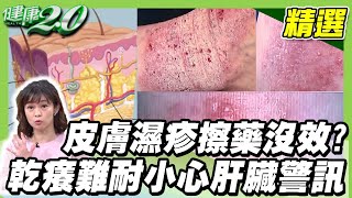 皮膚長濕疹擦藥沒效？ 濕疹奇癢無比止癢必學【健康2.0精選】