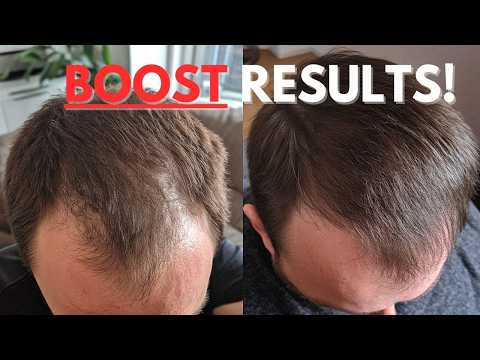 Increase Finasteride Hair Growth By +175% - Must Try!