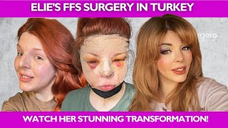 FFS SURGERY IN TURKEY W/ELIE