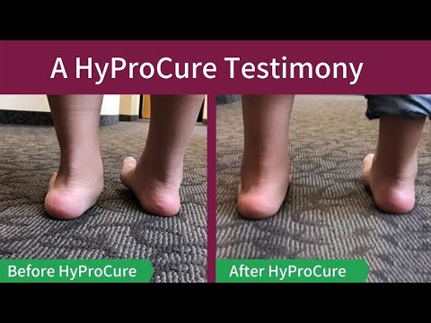 Meet Hector - How HyProCure Surgery Corrected Hyperpronation