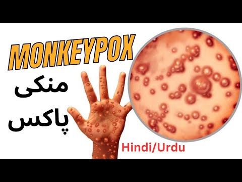 MonkeyPox: Causes: Sign & Symptoms: Treatment #MonkeyPox #chickenpox #drabbasofficial