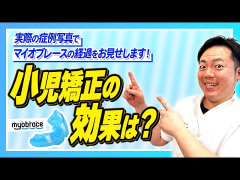 小児矯正の効果は？実際の症例写真で✨マイオブレース✨の経過をお見せします！🦷