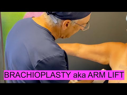 Full BRACHIOPLASTY aka ARM LIFT Surgery From PREOP to the Operating Room!