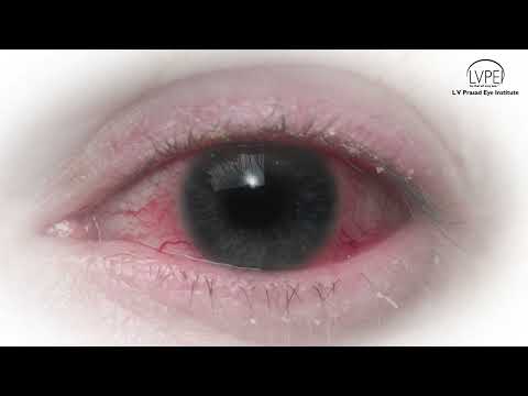 Learn what Conjunctivitis or Pink Eye is