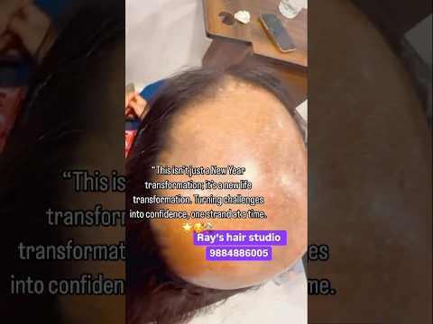 Permanent hair extensions best place in Chennai #song #wedding #baldheadproblem #hairstyle #hair