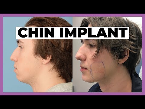 Cosmetic Surgery Patient Experience - Chin Implant