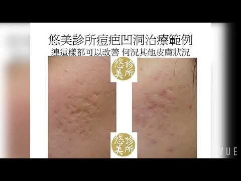 Time to eliminate acne scar 治療痘疤不只是雷射 其他治療更重要