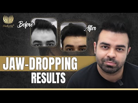 Jaw-Dropping Results | 8 Months Post Hair Transplant | MedLinks