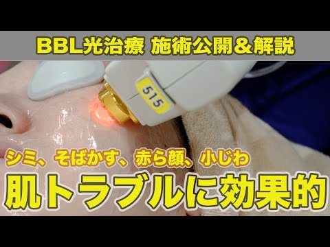 （施術動画）BBL光治療 シミ、そばかす、赤ら顔にお悩みの方必見！