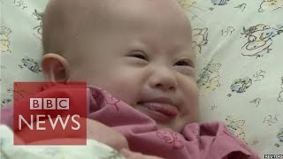 Baby Gammy: Conflicting claims about 'abandoned' b