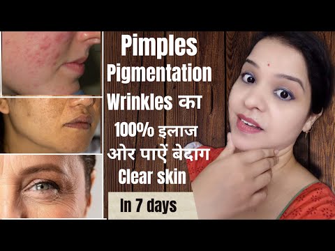 pimples acne marks pigmentation & wrinkles का 100% इलाज get clear young & glowing skin in 7 days