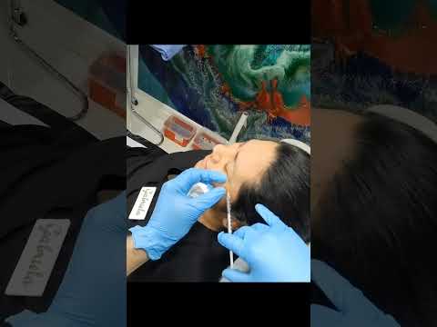 Say Goodbye to Crow's Feet: Botox Injections at Plantation Med Spa, Florida #shorts #crowsfeet