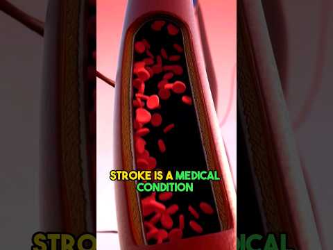 Understanding Stroke: Symptoms and Risk Factors #shorts #strokeawareness