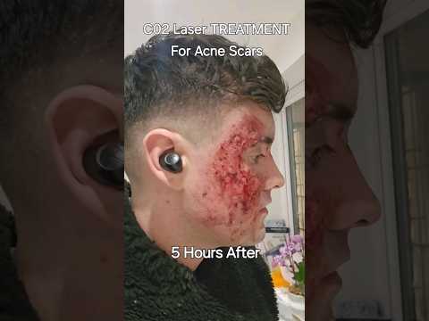 C02 Laser Acne Scars Before VS After