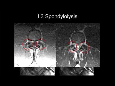 MRI of the Lumbar Spine | Part 9 - Lumbar Trauma