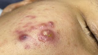 Satisfying With Loan Nguyen Spa Video (#064) #acnetreatment