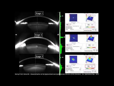 Diagnosis, staging and management of dysfunctional lens syndrome