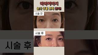 시술로 눈가 주름 탄력 관리가 가능하다면? #아이써마지 #눈주름 #눈가주름 #아이리쥬란 #시술 #시술후기 #EyeWrinkles #cosmetic