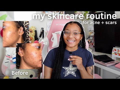 my skincare routine for acne & scars: sharing my journey, morning/nighttime routine, etc. (2024)