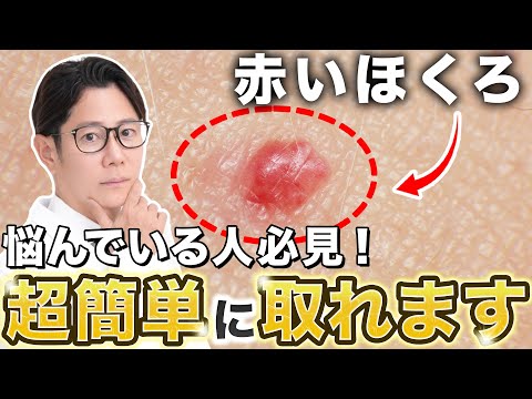 Japanese Dermatologist Explains Treatment of Cherry Angiomas