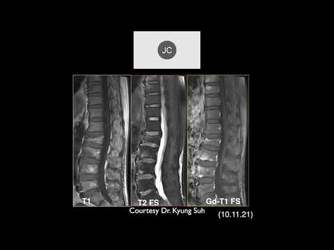 MRI of the Lumbar Spine | Part 6 - Lumbar Inflammation