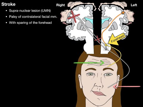 Bells Palsy and Stroke