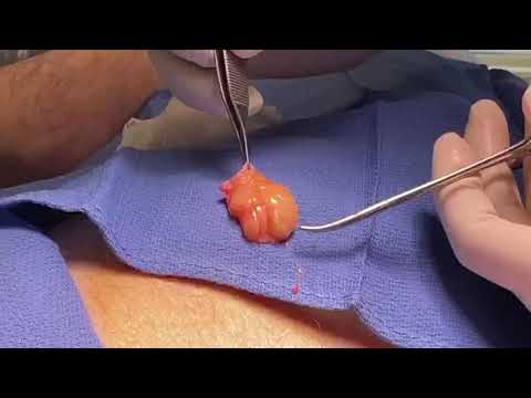 Removal of Subcutaneous Mass Under Local Anesthesia