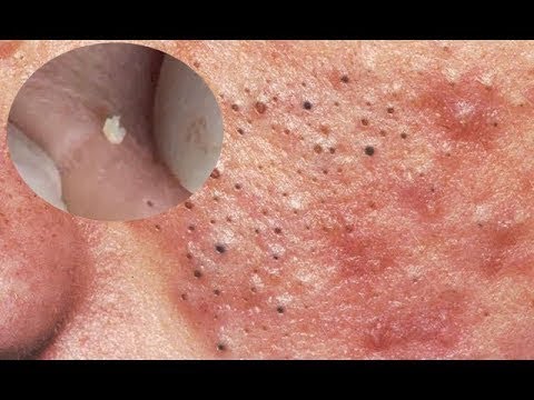 Deep Remove Acnes, Milia, Satisfying Video Face Skin Care