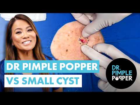 Dr Pimple Popper vs Small Cyst