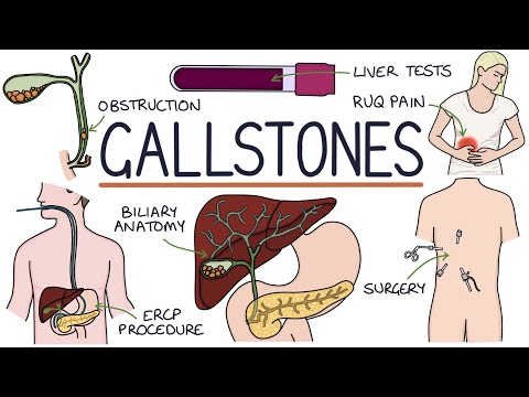 Understanding Gallstones