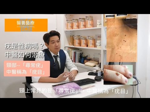 「疣」是性病嗎？如何形成？中醫如何治療？有甚麼分類？