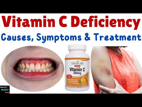 Vitamin C Deficiency – Causes, Symptoms, Diagnosis, Treatment & Prevention